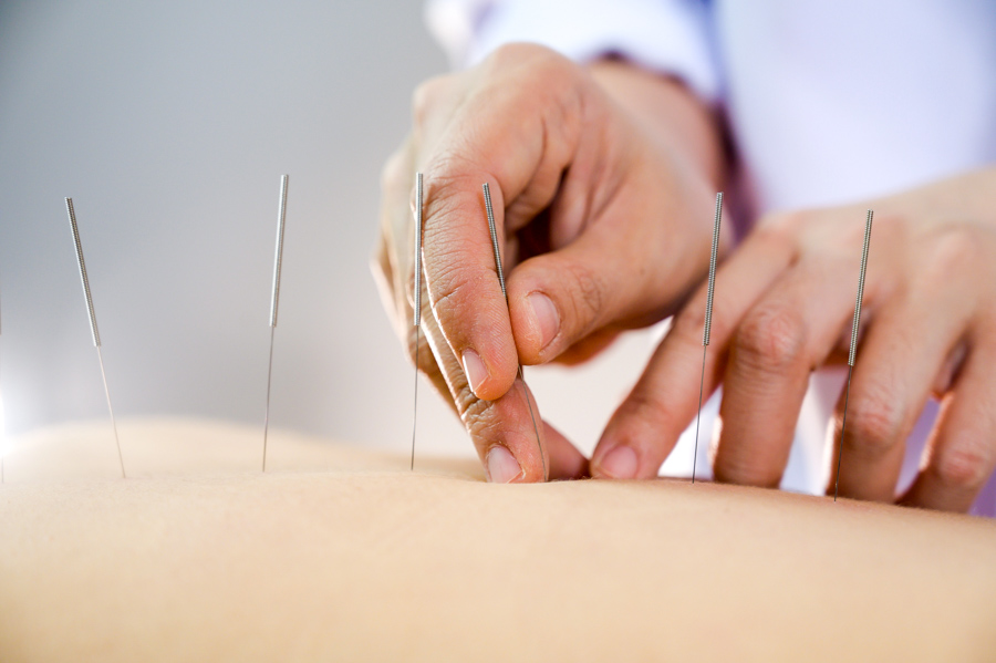 Traditional Chinese Medicine: Acupuncture