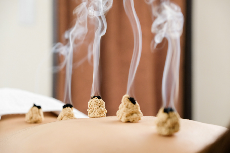 Traditional Chinese Medicine: Moxibustion