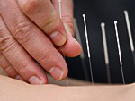 Acupuncture - Traditional Chinese Medicine